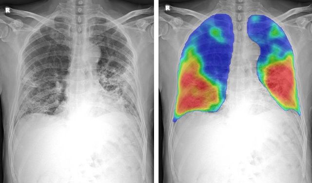COVID-19'un etkileri röntgenlerde çıkmaya başlayacak!