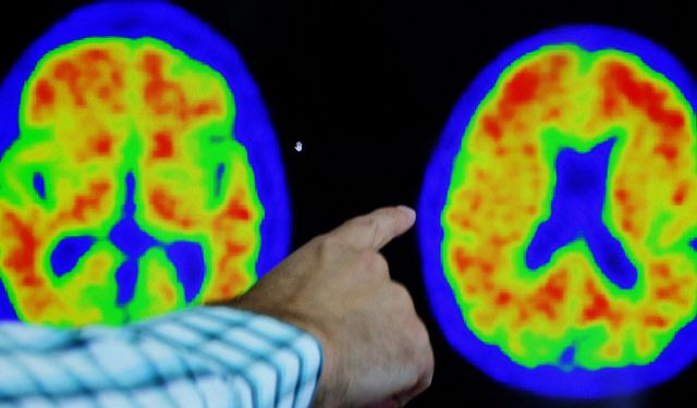 Alzheimer'ı yavaşlatan yeni bir ilaç bulundu!