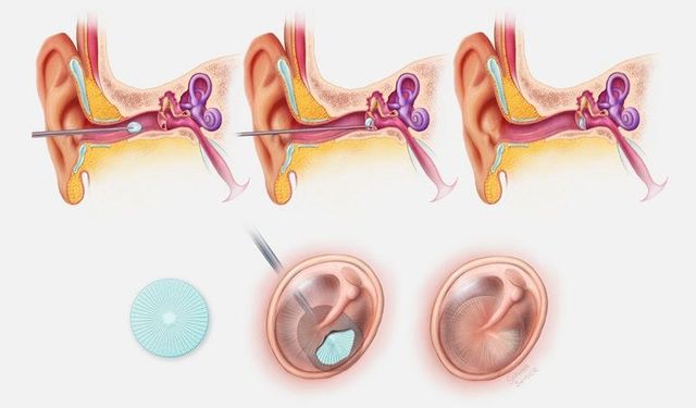 İşitme kaybını tamamen onaran 3D baskılı kulak zarı onarım yaması üretildi