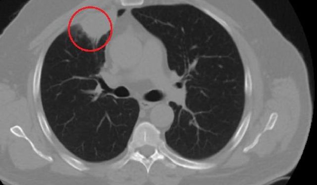 Dünyada bir ilk Türkiye'de yaşandı: COVID-19, akciğer kanserini taklit etti!